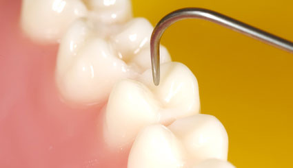 Zahnerhaltung in der Zahnarztpraxis DentalOase