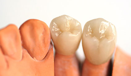 Zahnersatzi n der Zahnarztpraxis DentalOase